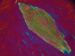 Jicht (artritis urica)