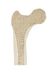 Osteogenesis imperfecta