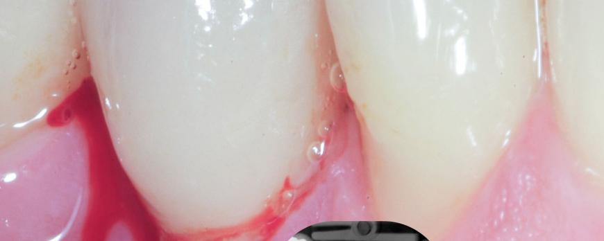 Peri-implantaire ontstekingen: van preventie tot behandeling