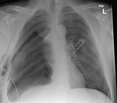 Quiz: acute dyspneu na pneumonectomie 