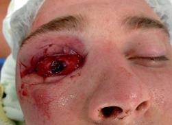 Oogletsels door vuurwerk