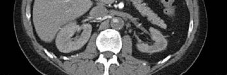 Chronische totale occlusie van de abdominale aorta 