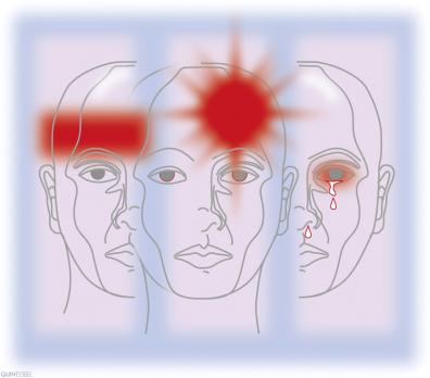 De fysiotherapeut als behandelaar van hoofdpijn (AF, BD, MT)