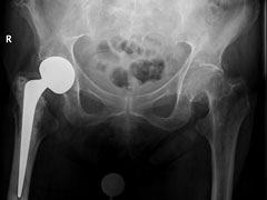 Heupfracturen: een overzicht voor de fysiotherapeut