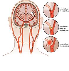 Cerebrovasculair accident (CVA)