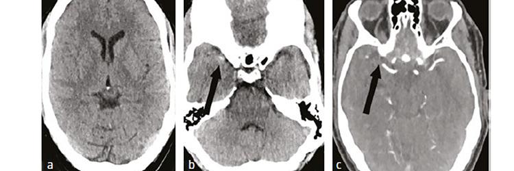 Patent foramen ovale (PFO) en herseninfarct