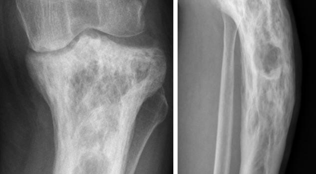 Quiz: pijn in knie en varusstand