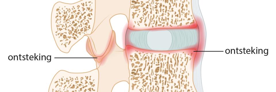 Vroege herkenning van axiale spondyloartritis door de fysiotherapeut