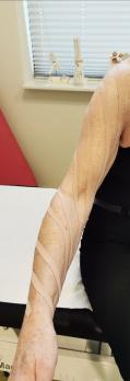 Wat is het effect van kinesiotaping op borstkankergerelateerd lymfoedeem van de arm?