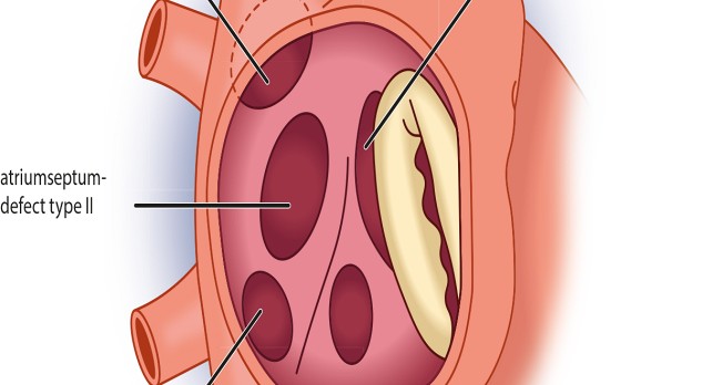 Congenitale hartafwijkingen: cardiale shunts