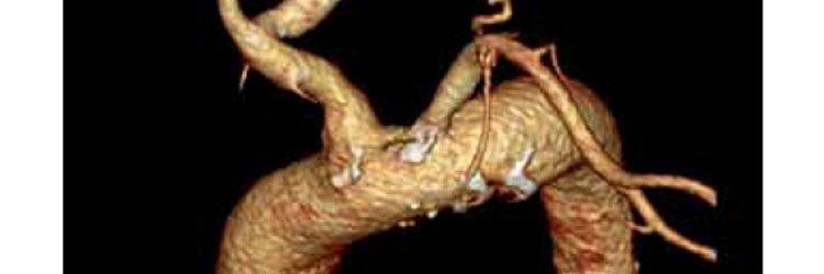 Mycotisch aneurysma van de coronairarterie