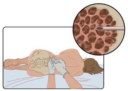Acute lymfatische leukemie bij kinderen