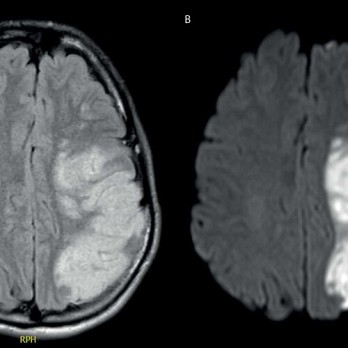 Young stroke bij atherosclerose als gevolg van hyperhomocysteïnemie