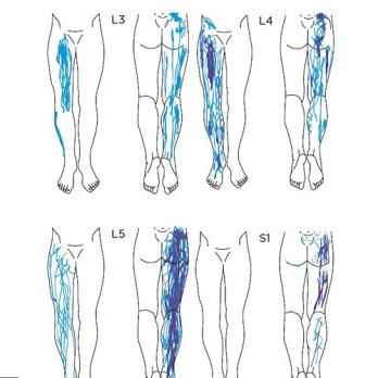 Wat is de diagnostische waarde van de pijnlocatie bij lage rugpijn?
