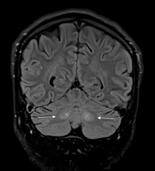 Cerebellair syndroom als uiting van metabole stoornissen