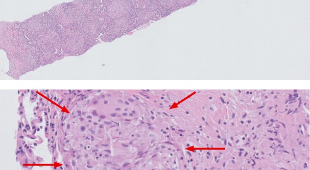 Neurosarcoïdose