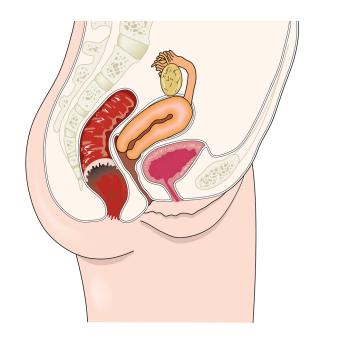 Behandeling met infliximab bij kinderen en adolescenten met de ziekte van Crohn