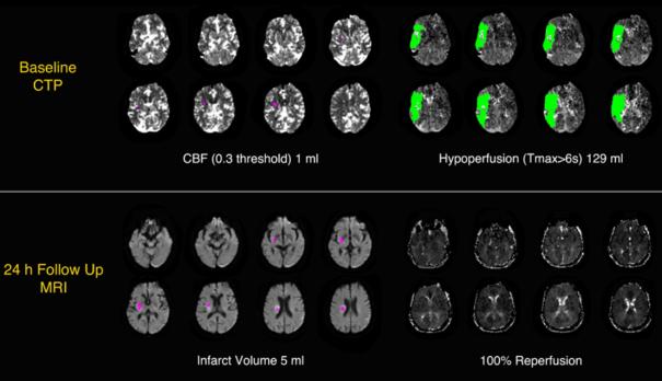 DAWN-trial – is imaging belangrijker dan duur van symptomen bij IAT?