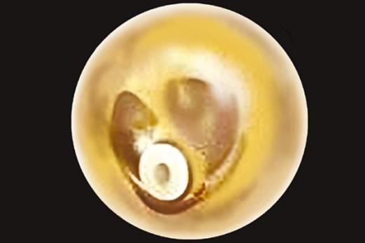 Adenotomie en trommelvliesbuisjes, zin en onzin