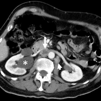 Acute buikpijn bij oncologische patiënten