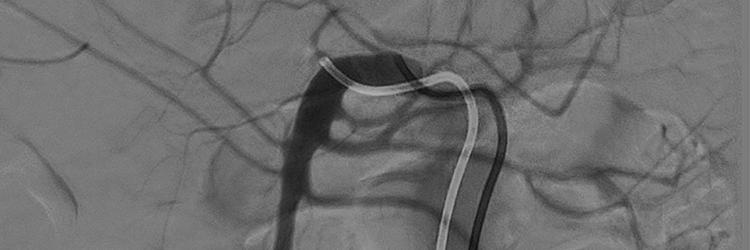 Interventieradiologische behandeling van acute bloedingen