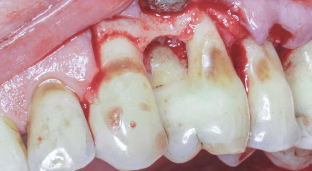 Parodontale chirurgie