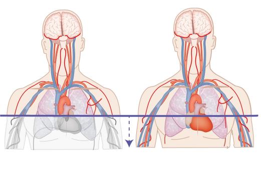 CT-hart tijdens de acute opvang bij het herseninfarct