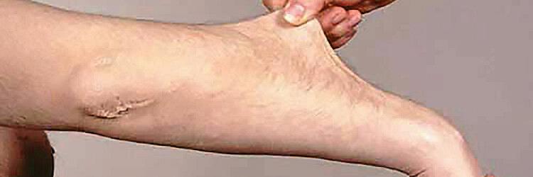 De invloed van stofwisselingsstoornissen op bindweefsel (AF/BD)