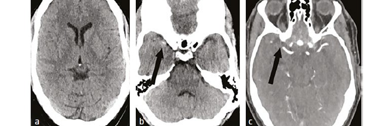 Acute behandeling van het herseninfarct 