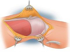 De totale knieprothese