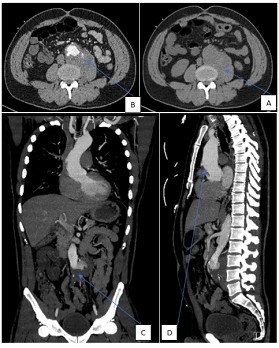 Infectieuze aortitis