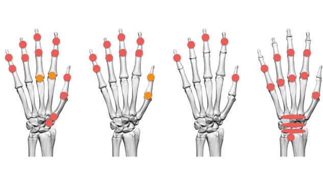 Handartrose in revalidatie