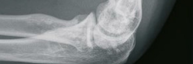 Quiz: afwijkende skeletfoto's