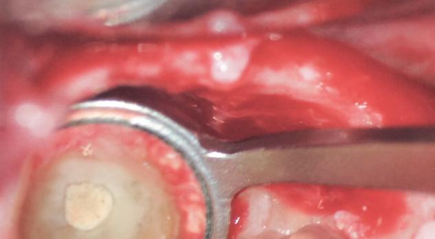 Apicale microchirurgie