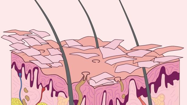 Psoriasis