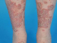 Psoriasis vulgaris