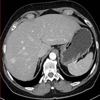 Nieuwe hypervasculaire leverlaesies na behandeling met chemotherapie 