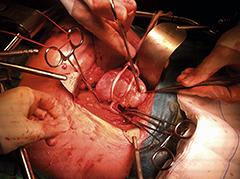 Niertransplantatie – de procedure en het beloop rondom de operatie