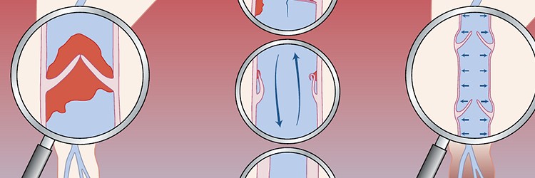 Ontwikkelingen in de preventie en behandeling van cardiale infecties 