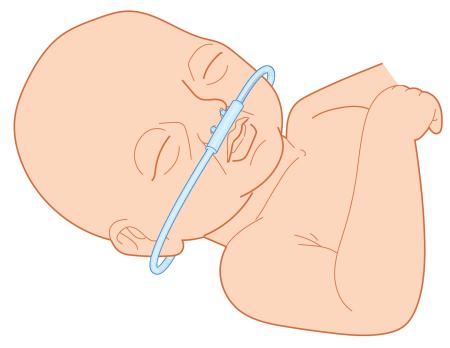 Niet-invasieve respiratoire ondersteuning bij prematuren