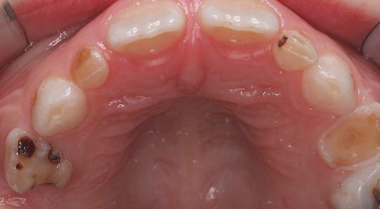Risicoschatting bij cariësdiagnostiek en -behandeling