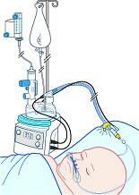 High-flowzuurstof- therapie bij bronchiolitis