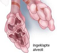 Atelectase