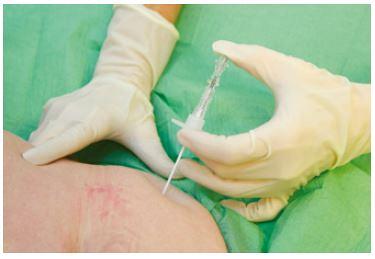 Ascitespunctie in de palliatieve fase