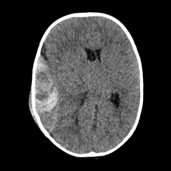 Een afwijkende CT-scan bij een kind met traumatisch hoofdletsel 