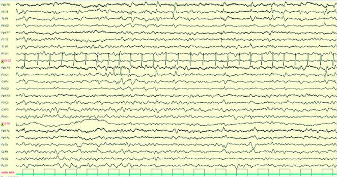 Een febriele status epilepticus, lang niet altijd onschuldig 