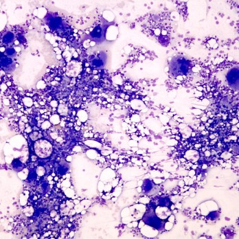 Essentiële trombocytose en de verworven Von Willebrand deficiëntie