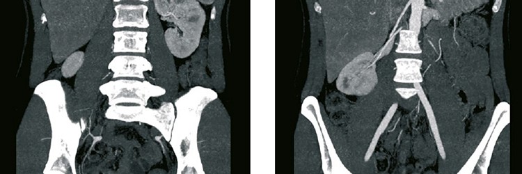 Hypertensie door een wandering kidney