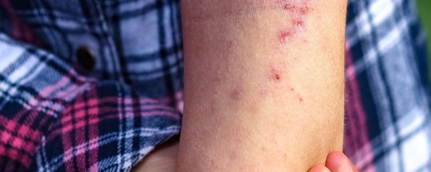 Dermatocorticosteroïden in de behandeling van eczeem bij ouderen