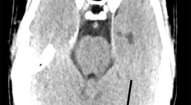 Infectieuze endocarditis